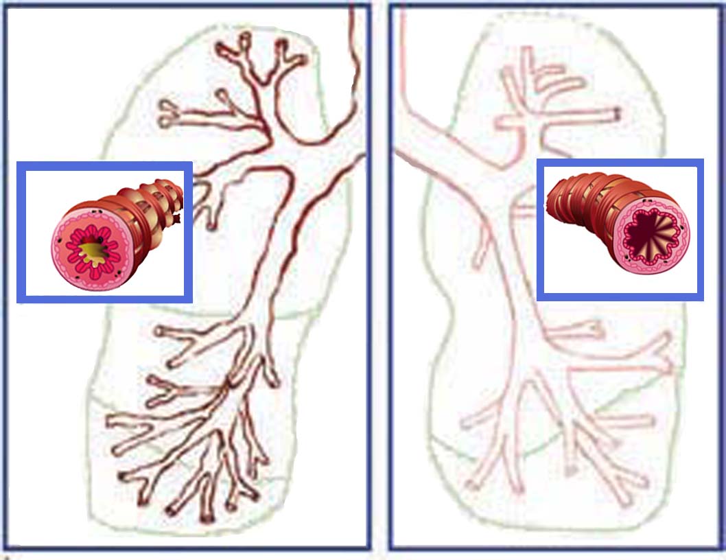asthma diagram